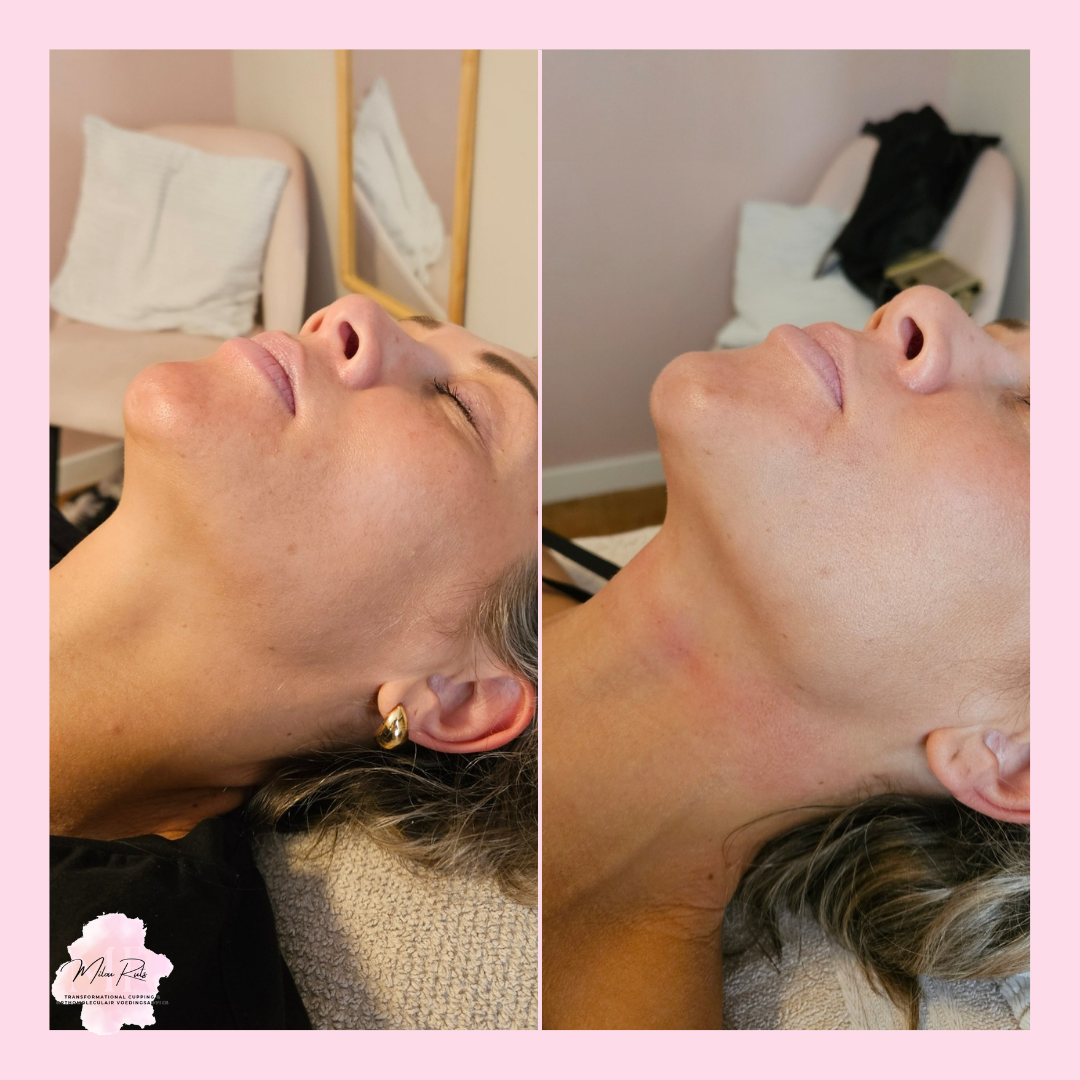 Gezichtsbehandeling resultaat 2