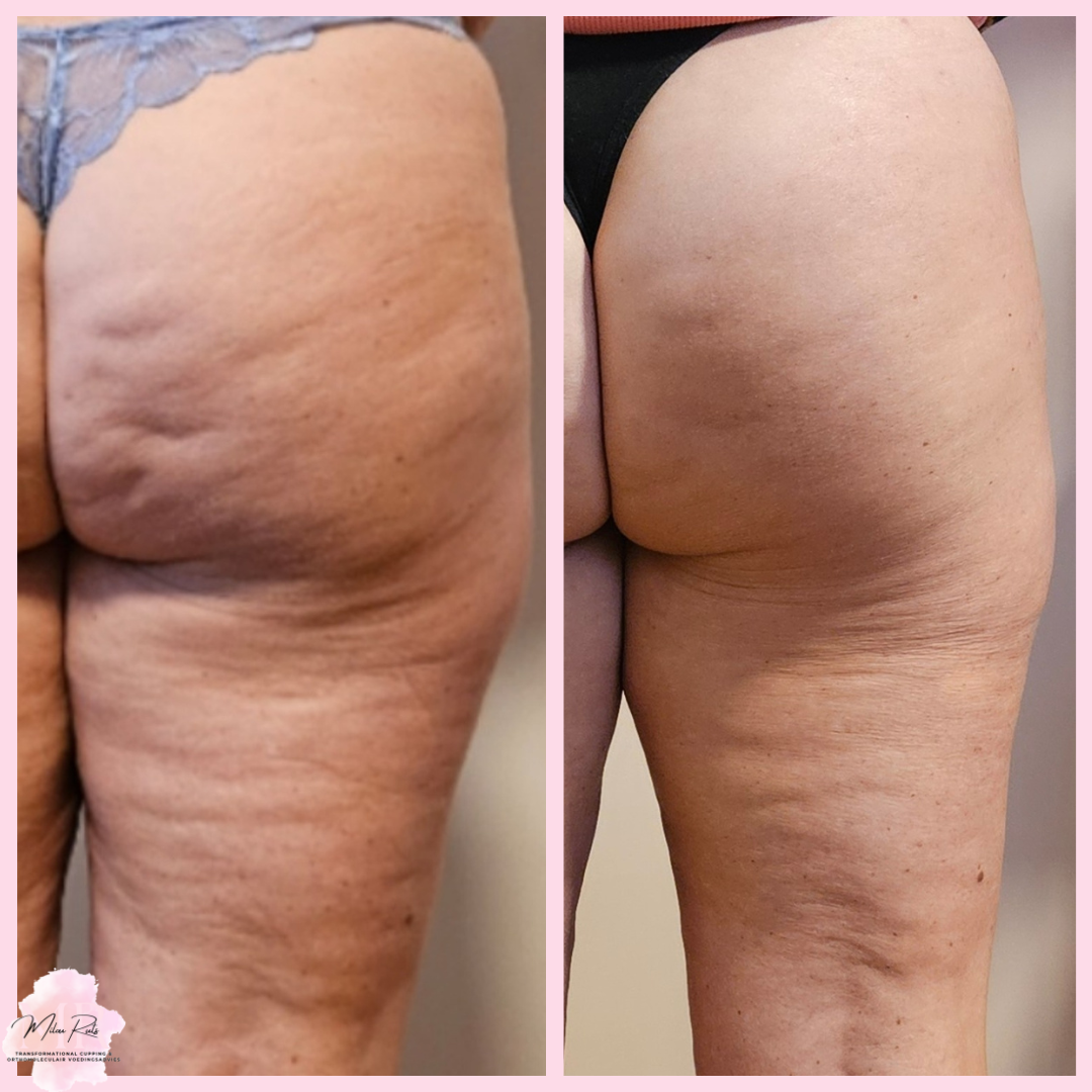 Transformational Cupping resultaat 2